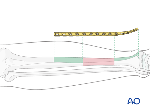 Plate length is based upon symmetry above and below the fracture zone. At least 3-4 screw holes on either side of the fracture.