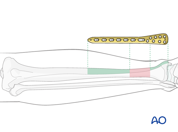 When the fracture zone is very distal or proximal, there may not be enough room for symmetric plate length in the segment...