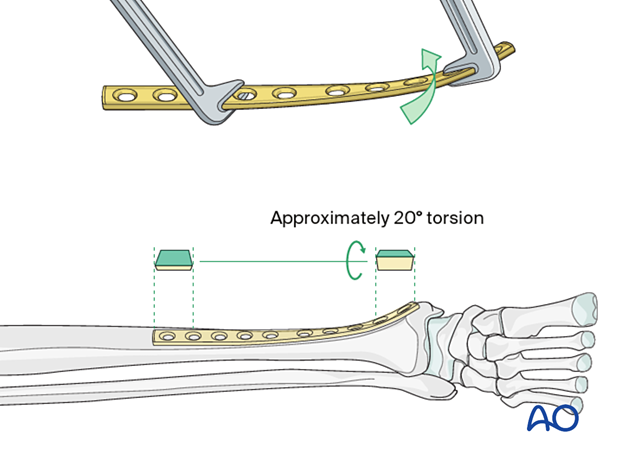 orif lag screws with protection plate – Plate preparation