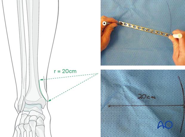 orif lag screws with protection plate – Plate preparation
