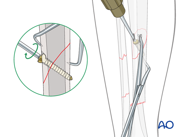 C2 tibial shaft fracture: If an oblique fracture is long enough, a percutaneous lag screw can be used to compress the final reduction.