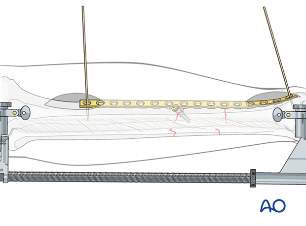 C2 tibial shaft fracture: Position of the plate is adjusted on both the AP and lateral views.