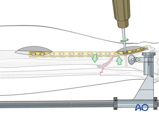 Tibial shaft MIO compression plating – initial screw placement