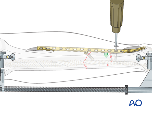 C2 tibial shaft fracture: Through an image-directed stab wound, place the first screw according to antiglide principles.