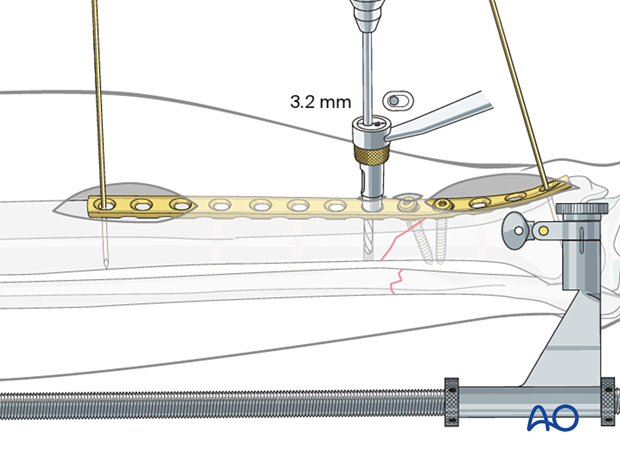 Tibial shaft MIO compression plating – compression screw