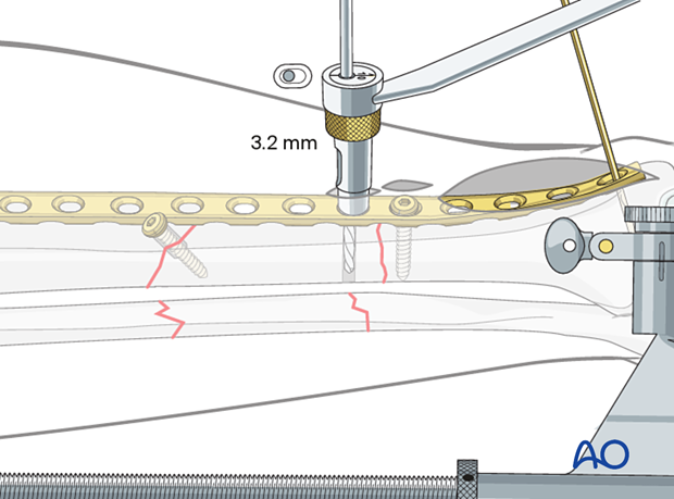C2 tibial shaft fracture: Fracture compression is applied after reduction.