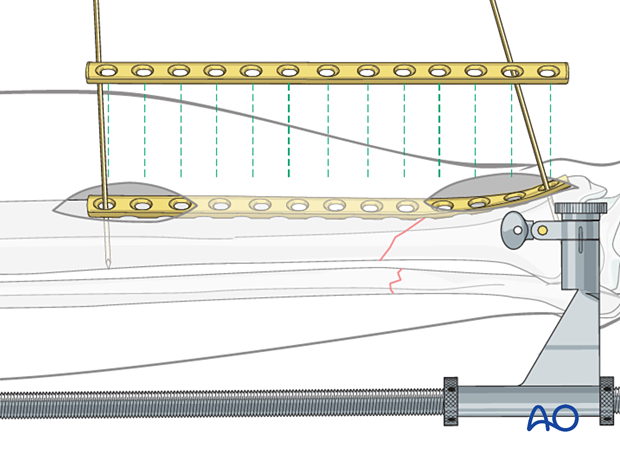 Tibial shaft MIO compression plating –screw placement 