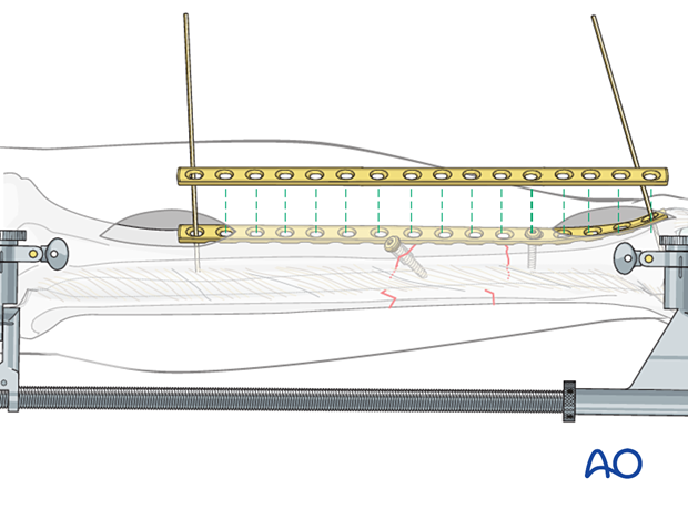 C2 tibial shaft fracture: Screws can be inserted into both ends of the plate through the small incisions made to insert the plate.