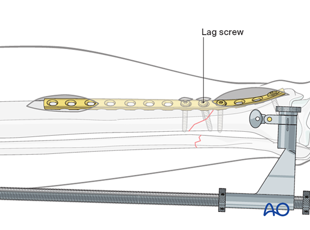 Tibial shaft MIO compression plating – Interfragmentary lag screw