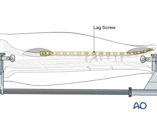 C2 tibial shaft fracture: For sufficiently oblique fractures, absolute stability is best achieved by compressing the fracture plane.