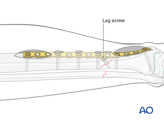 Tibial shaft MIO compression plating – Interfragmentary lag screw 