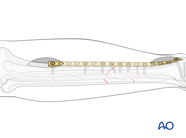 C2 tibial shaft fracture: Place the remaining screws spreading the fixation.