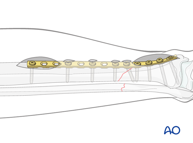 A2 tibial shaft fracture