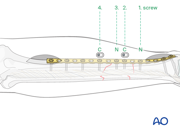 C2 tibial shaft fracture: Multiple techniques are possible depending upon fracture location and obliquity.