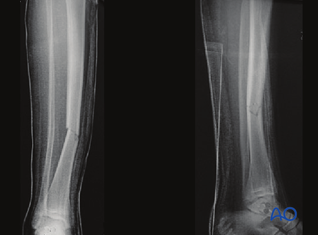 Tibial shaft MIO compression plating – Case example of an A2 tibial shaft fracture