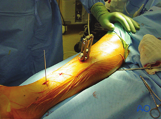 Tibial shaft MIO compression plating – Case example of an A2 tibial shaft fracture