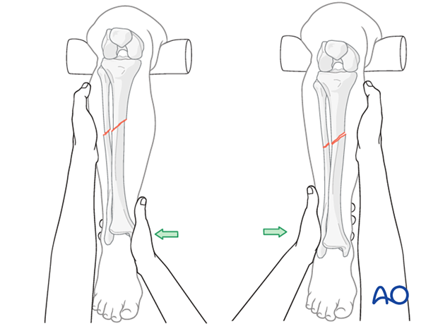 nonoperative casting, Correction of angulation