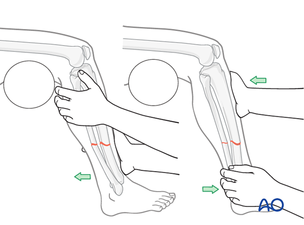 nonoperative casting, Correction of angulation