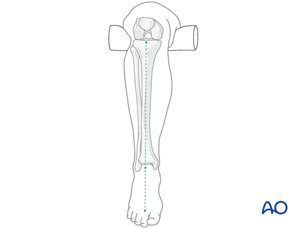 nonoperative casting, Correction of rotation