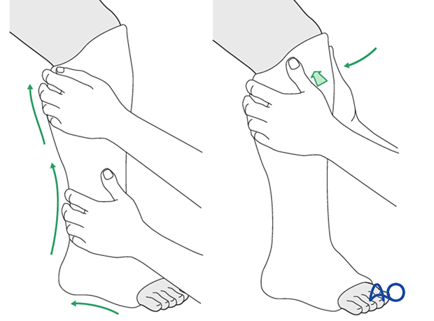nonoperative casting, Application of a long leg cast
