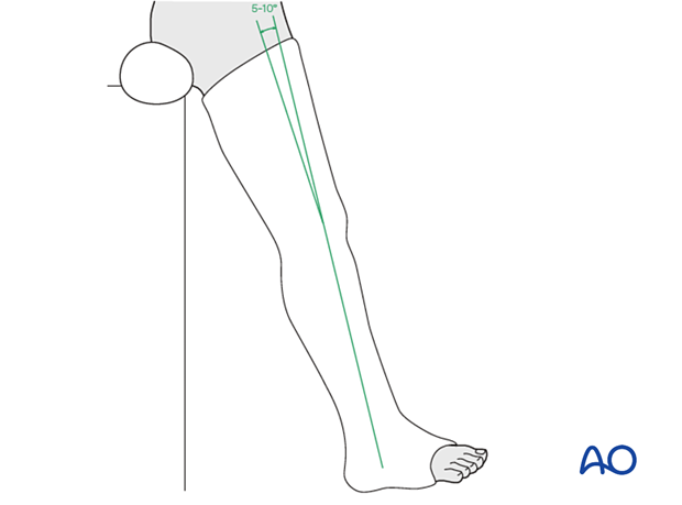 nonoperative casting, Application of a long leg cast