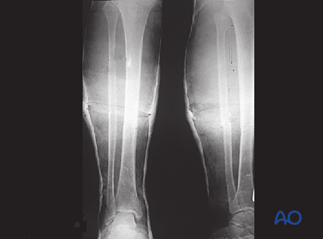 Nonoperative treatment (casting) for Multifragmentary fracture, intact ...