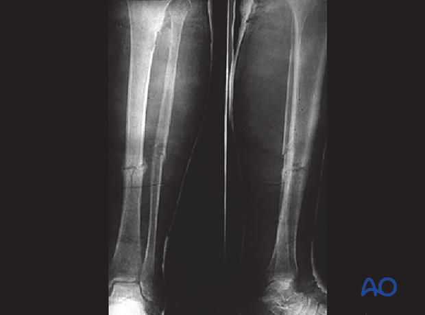 nonoperative casting, Case presentation: wedge cast
