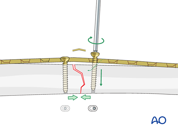 42_P090_A3_i080 Simple transverse tibial fracture: orif compression plating Overbending the plate