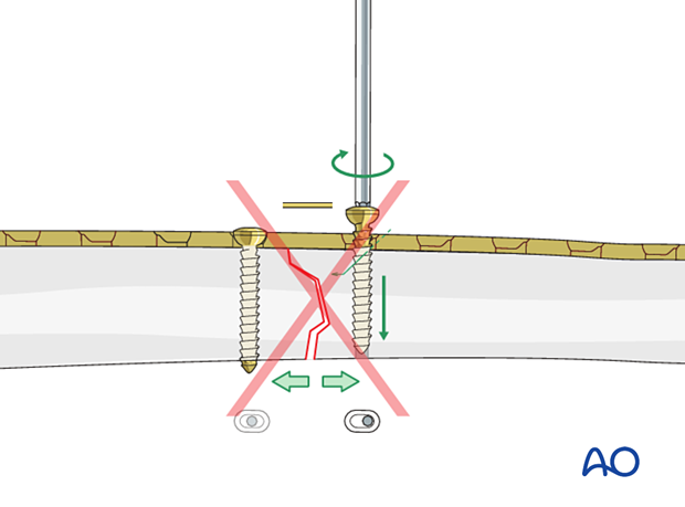 42_P090_A3_i090 Simple transverse tibial fracture: orif compression plating Axial compression applied with a plate not overbent
