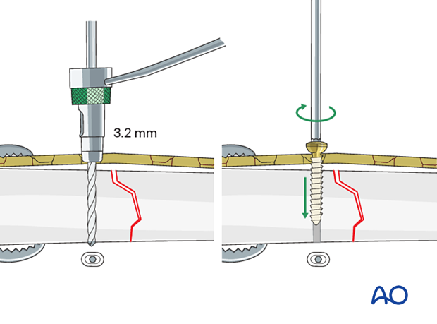 42_P090_A3_i180 Simple transverse tibial fracture: orif compression plating Insertion of the first screw