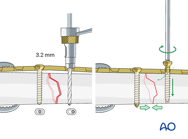 42_P090_A3_i200 Simple transverse tibial fracture: orif compression plating Axial compression with eccentric screw