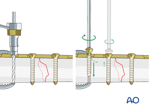 42_P090_A3_i220 Simple transverse tibial fracture: orif compression plating Insertion of second eccentric screw
