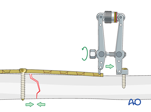 42_P090_A3_i260 Simple transverse tibial fracture: orif compression plating Compression with the ATD