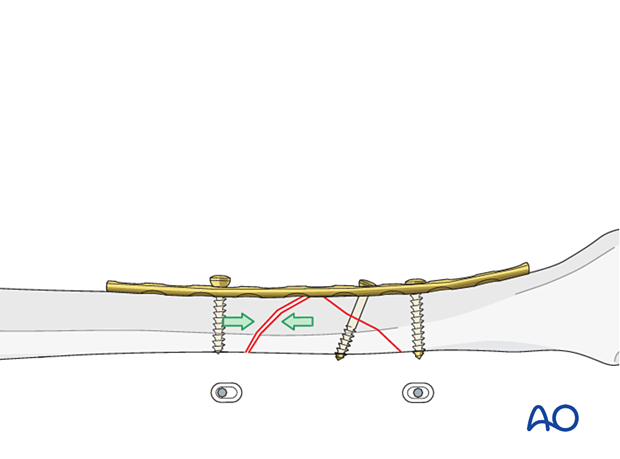 Tibial shaft B2 fracture orif compression plating - Dynamic compression principle