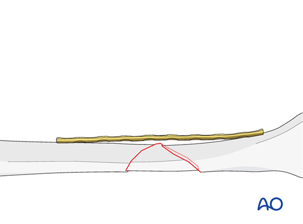 Tibial shaft B2 fracture orif compression plating -overbending the plate