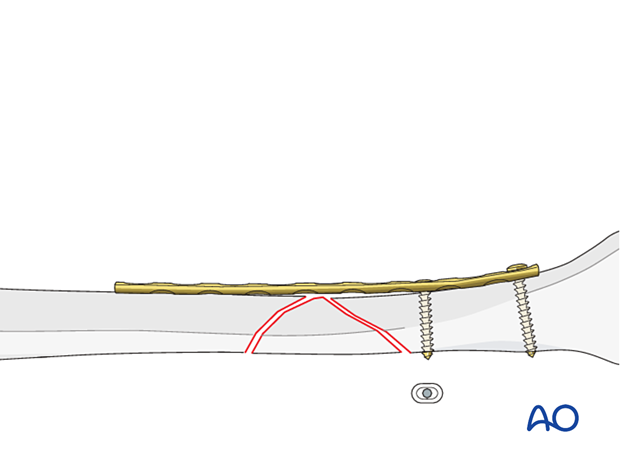 Tibial shaft B2 fracture orif compression plating -application of the plate