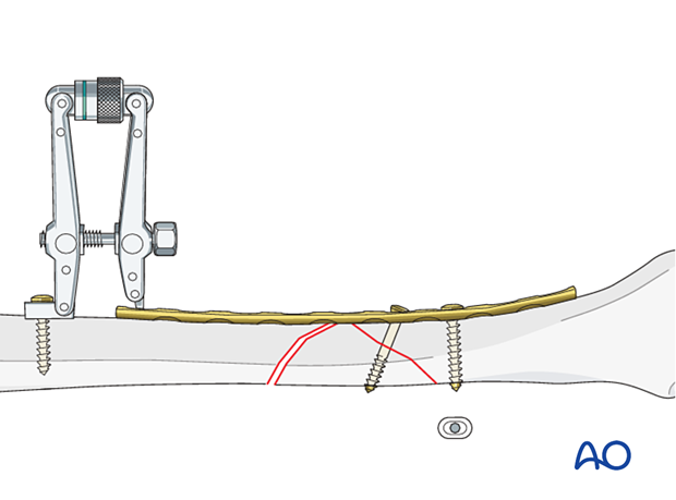 Tibial shaft B2 fracture orif compression plating -lag screw fixation