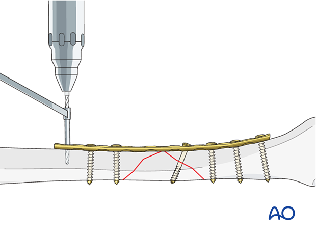 Tibial shaft B2 fracture orif compression plating -screw insertion