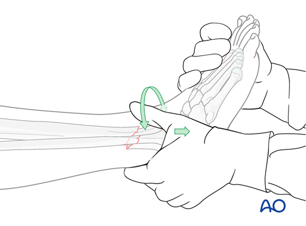 Tibial shaft multifragmentary fracture, intact segmental: manual reduction