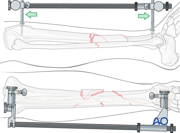 Tibial shaft multifragmentary fracture, intact segmental: A large distractor is very helpful for reduction.