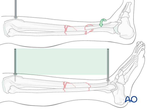 Tibial shaft multifragmentary fracture, intact segmental: Rotational alignment must be considered during application of the distractor or external fixator.