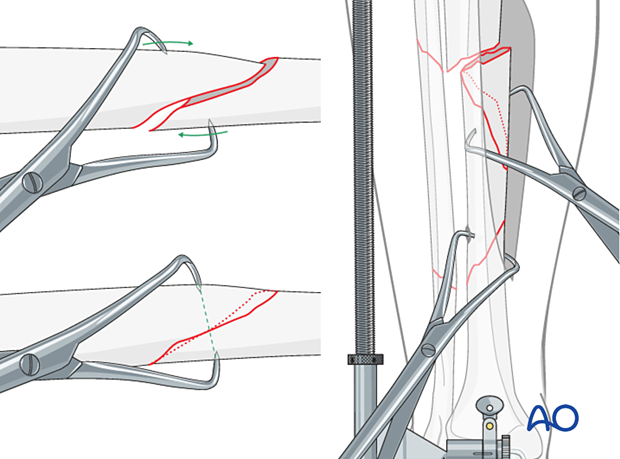 Tibial shaft multifragmentary fracture, intact segmental: Reduction of the wedge fragments and oblique fracture lines can be obtained with  pointed reduction forceps.