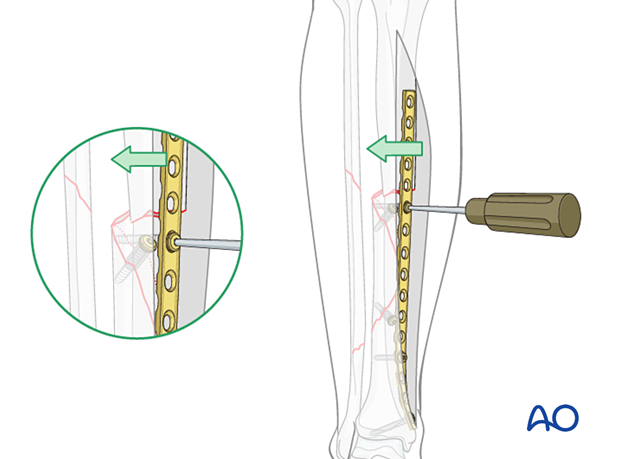 Tibial shaft multifragmentary fracture, intact segmental: Correction of translation is performed by applying a well-contoured plate.
