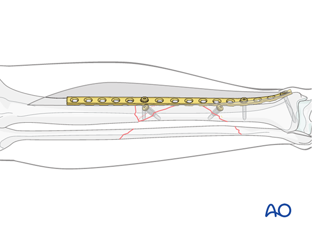 Tibial shaft multifragmentary fracture, intact segmental: orif compression plating