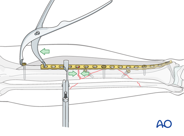Tibial shaft multifragmentary fracture, intact segmental: A Verbrugge clamp in combination with a push-pull screw can be used to compress across the transverse fracture.