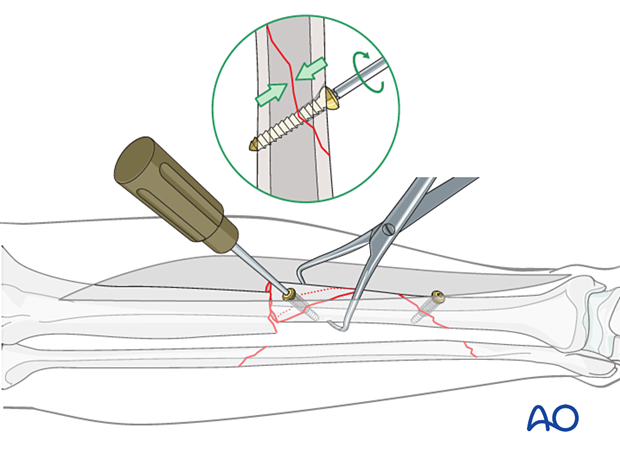 Tibial shaft multifragmentary fracture, intact segmental: lag screw insertion