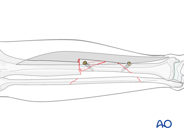 Tibial shaft multifragmentary fracture, intact segmental: Lag screws should not be allowed to interfere with the plate. If possible, place them outside the plate’s footprint.