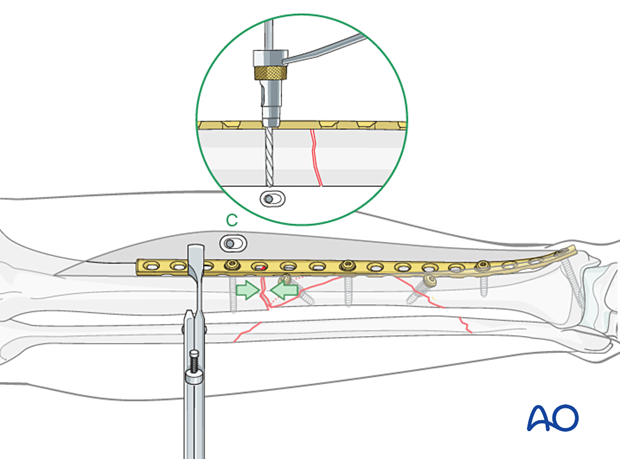 Tibial shaft multifragmentary fracture, intact segmental: With the fracture reduced and plate properly positioned, drill eccentrically (load position) for the first screw