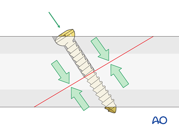 orif lag screws with protection plate – introduction of lag screw