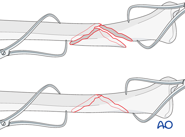 orif lag screws with protection plate - reduction